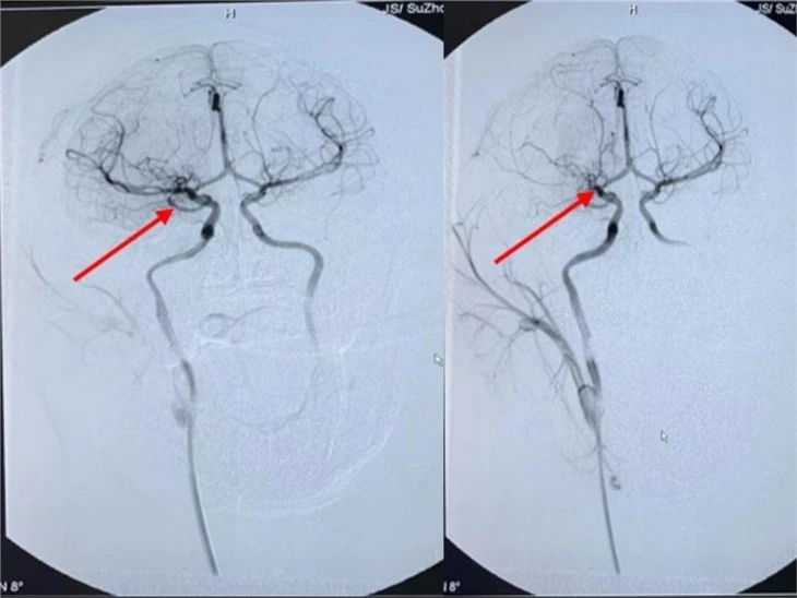 Middle Cerebral Artery Occlusion (MCAO) NHP Model Of Stoke & Brain Ischemia